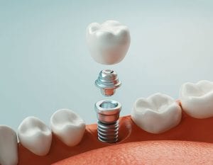 What You Need to Know About Dental Implants
