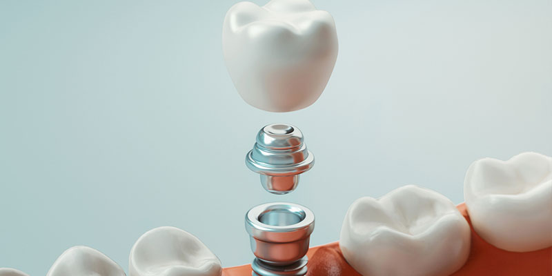 What You Need to Know About Dental Implants 