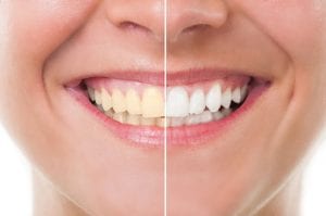 Dental-Approved Teeth Whitening Tips that Really Work!