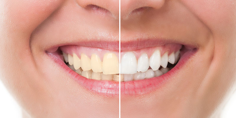 Dental-Approved Teeth Whitening Tips that Really Work!