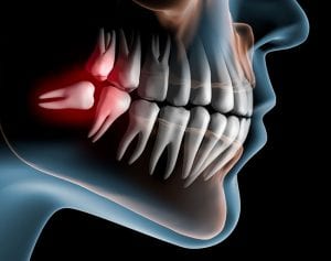 5 Signs It’s Time For Wisdom Teeth Removal