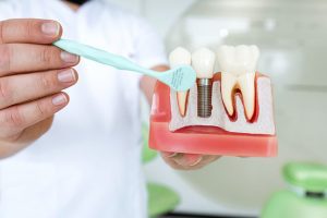 Are Dental Implants Right for You?