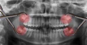 Why Wisdom Teeth Removal is Necessary for Your Dental Health