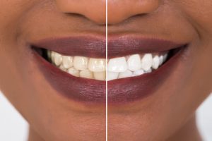 Correcting Common Misconceptions About Teeth Whitening