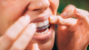 Three Teeth Whitening Myths You Should Not Believe