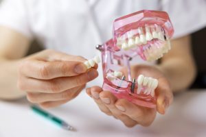 The 4 Main Types of Dental Bridges and Who Should Consider Getting Them
