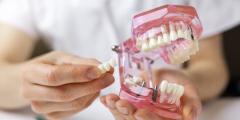 The 4 Main Types of Dental Bridges and Who Should Consider Getting Them