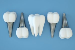 Three Things You Should Know About Dental Implants