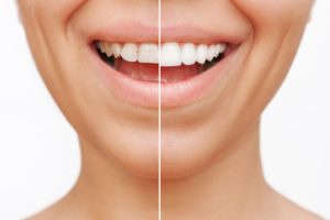 Commonly Asked Questions About Veneers