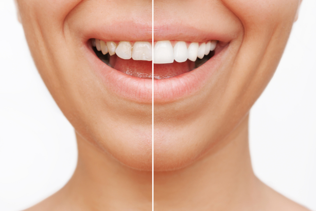 Commonly Asked Questions About Veneers