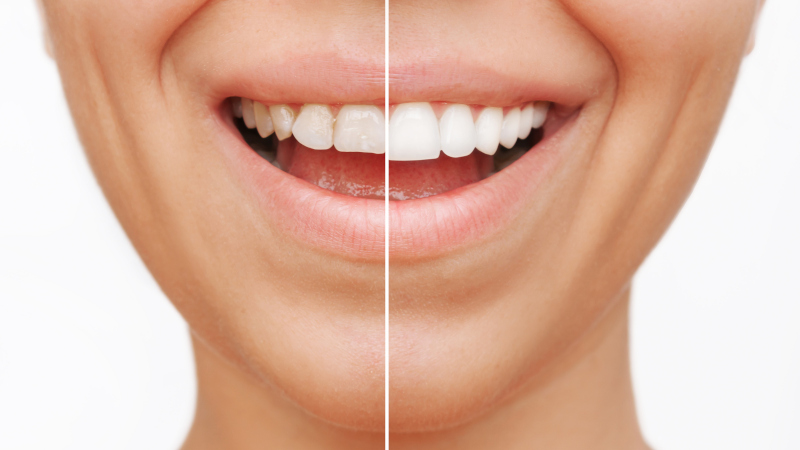 Commonly Asked Questions About Veneers