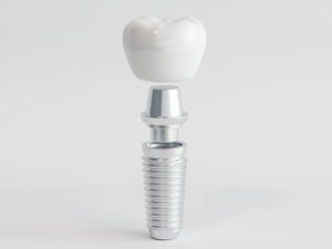 5 Signs You Could Be a Good Candidate for Dental Implants