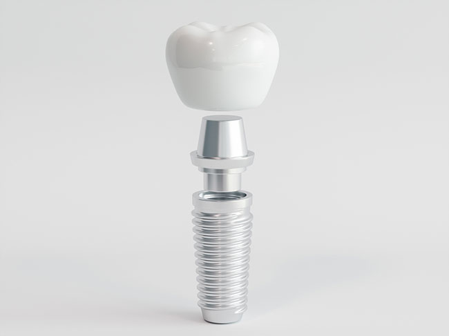 5 Signs You Could Be a Good Candidate for Dental Implants