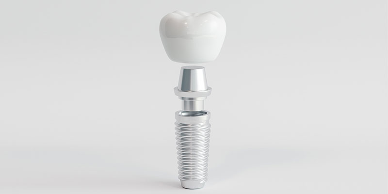 5 Signs You Could Be a Good Candidate for Dental Implants